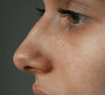 גידולים באף: הסימפטומים, האבחון והטיפול-תמונה